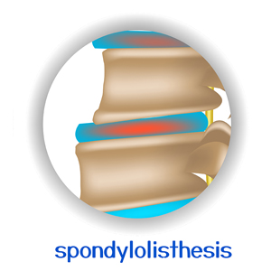 picture of Largo spondylolisthesis